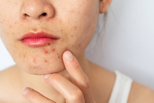 Ini Akibat Tidak Bersihkan Makeup, Bisa Jerawatan hingga Penuaan Dini