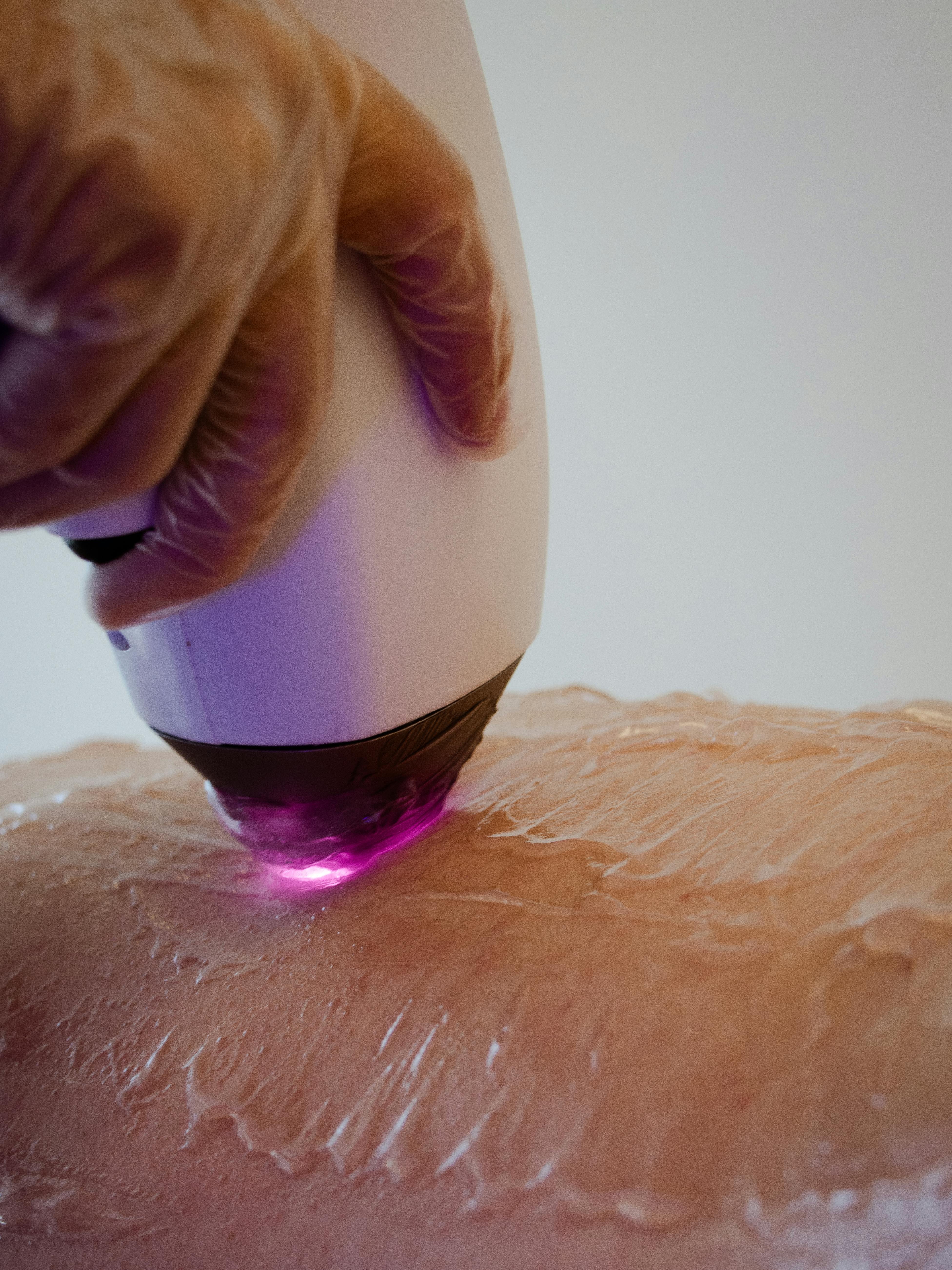 Bukan Sulap Bukan Sihir! Begini Cara IPL Hair Removal Bekerja untuk Kulit Mulus