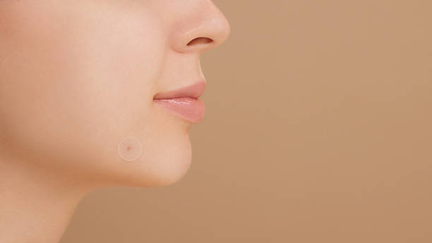 Kelebihan dan Kekurangan Menggunakan Pimple Patch