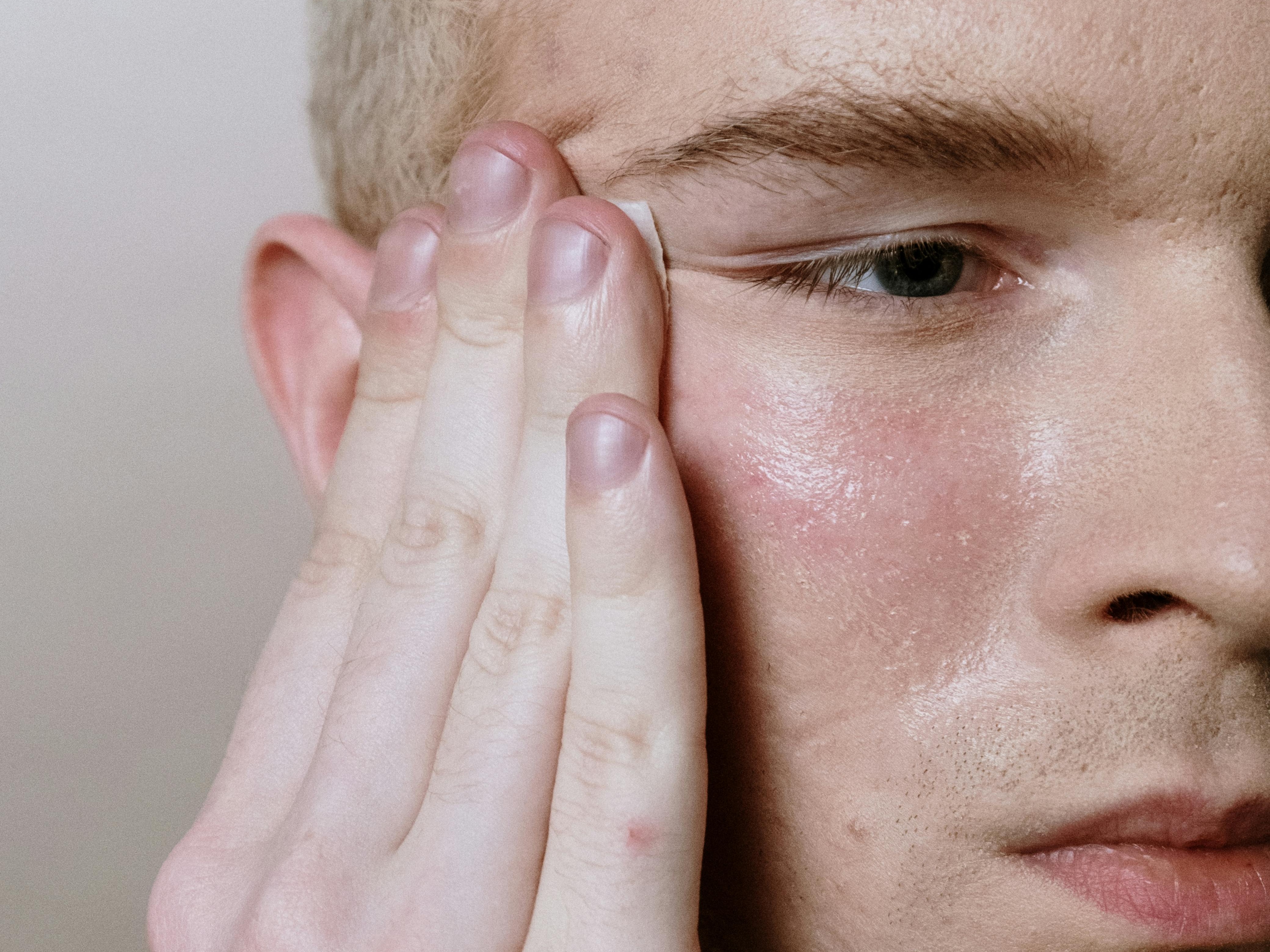 Baru Pakai Salicylic Acid? Ini Panduan Lengkap Agar Bekas Jerawat Cepat Pudar Tanpa Iritasi