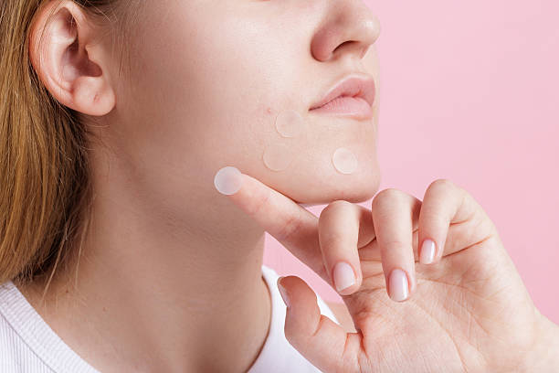 Kelebihan dan Kekurangan Menggunakan Pimple Patch