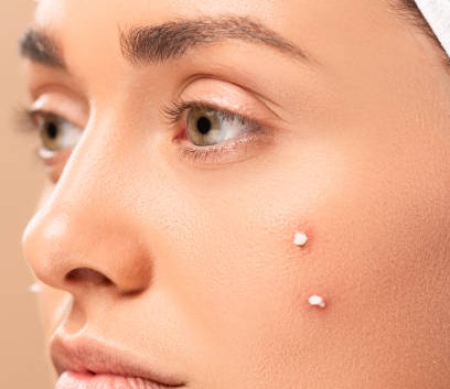 Obat Acne Spot Dipakai Setelah Apa? Perhatikan Hal-hal Ini Dulu