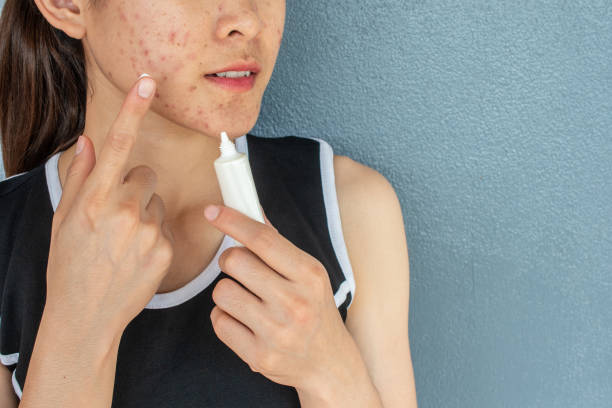 Obat Acne Spot Dipakai Setelah Apa? Perhatikan Hal-hal Ini Dulu