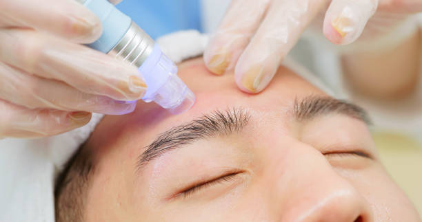Apakah Blackhead Remover Vacuum Benar-Benar Efektif? Fakta & Mitos yang Perlu Kamu Tahu