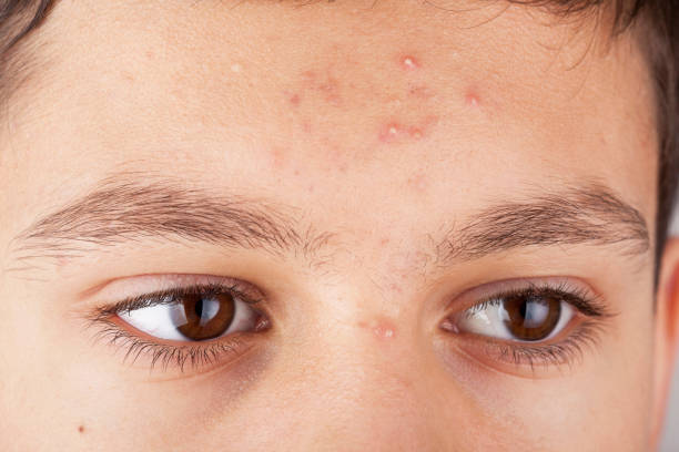 Pilihan Sunscreen untuk Kulit Berjerawat yang Aman dan Ringan
