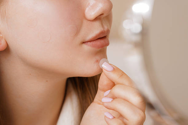 Kapan Waktu yang Tepat Menggunakan Pimple Patch?