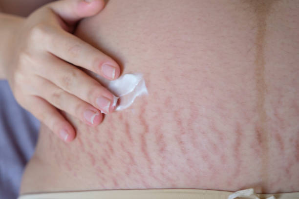 Bumil Wajib Tahu! Ini Cara Samarkan Stretch Marks yang Bisa Dicoba