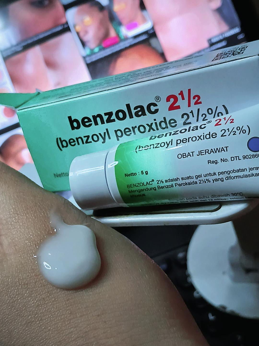 Mengapa Benzolac 2,5% Disebut Hidden Gem Perawatan Jerawat?