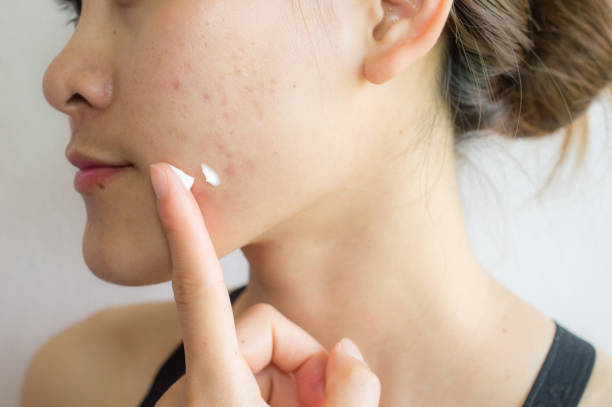 Cara Aman Memilih Skincare untuk Kulit Berjerawat agar Tidak Iritasi