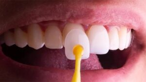 Pengen Veneer atau Bleaching? Baca Dulu Panduan Aman Biar Nggak Menyesal