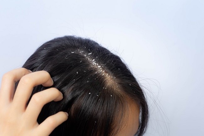 Jangan Salah Kira: Ketombe atau Psoriasis? Ini Cara Bedain dan Nanganinnya