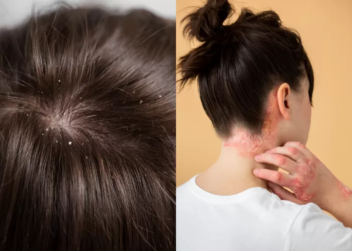 Jangan Salah Kira: Ketombe atau Psoriasis? Ini Cara Bedain dan Nanganinnya