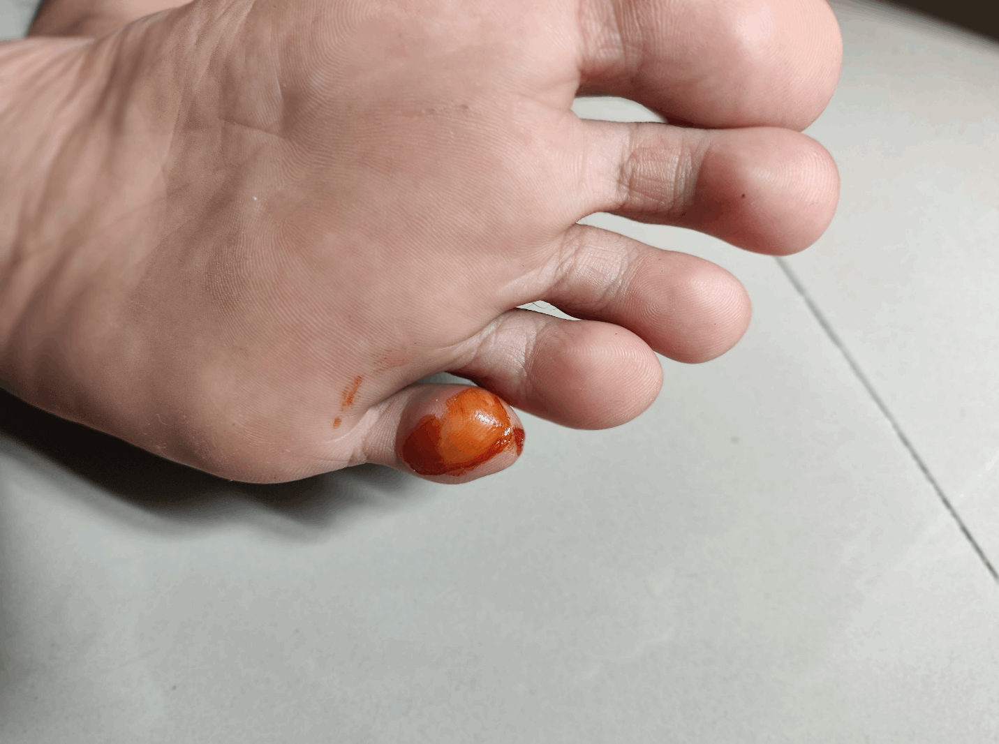 Belajar dari Blister: Kenapa Sepatu Lari Harus Di-Upsize Kalau Mau Finish Marathon?