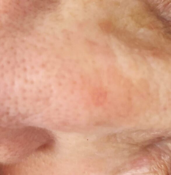 Keratosis Aktinik: Dari Bercak “Sepele” Jadi Ancaman Serius, Apa yang Harus Kamu Lakukan?