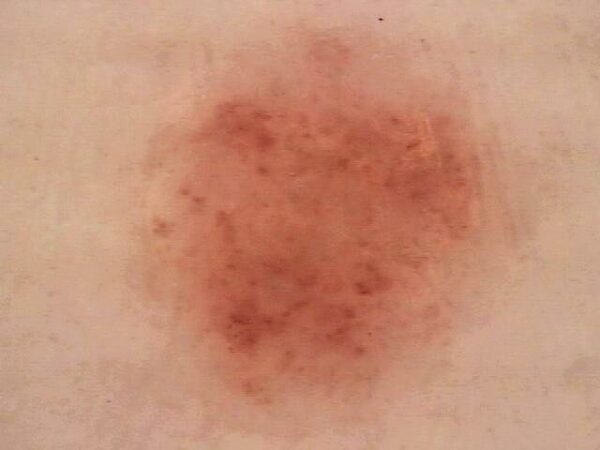 Keratosis Aktinik: Dari Bercak “Sepele” Jadi Ancaman Serius, Apa yang Harus Kamu Lakukan?