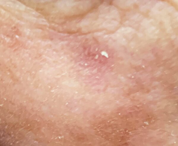Keratosis Aktinik: Dari Bercak “Sepele” Jadi Ancaman Serius, Apa yang Harus Kamu Lakukan?