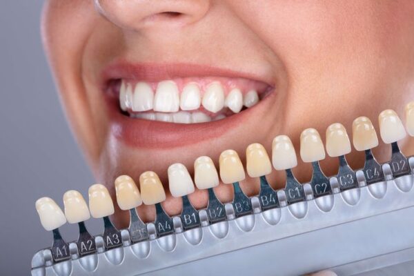 Pengen Veneer atau Bleaching? Baca Dulu Panduan Aman Biar Nggak Menyesal