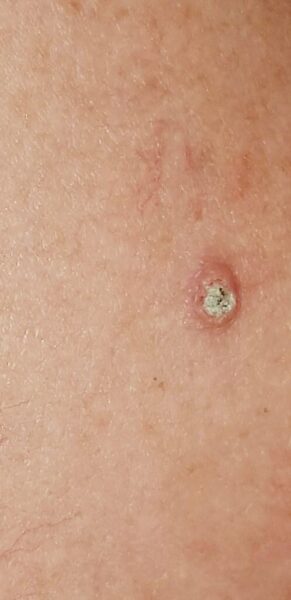 Keratosis Aktinik: Dari Bercak “Sepele” Jadi Ancaman Serius, Apa yang Harus Kamu Lakukan?