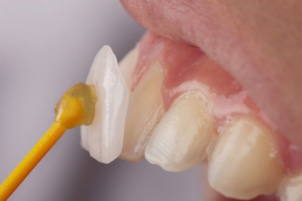 Bleaching vs Veneer: Rahasia Senyum Cerah Pria Modern yang Jarang Dibahas