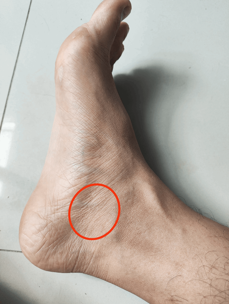 Belajar dari Cidera Tendon: Ambisi Marathon yang Kebablasan