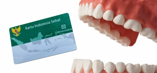 Cara Cerdas Dapat Gigi Palsu Bersubsidi BPJS: Hemat Jutaan Tanpa Ribet