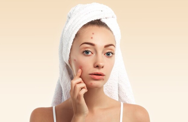 Kulit Berminyak Tapi Pengen Bebas Jerawat? Ikuti 10 Trik Simple Ini!