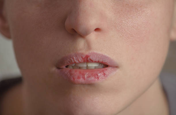 5 Kesalahan Pakai Lip Scrub yang Bikin Bibir Perih