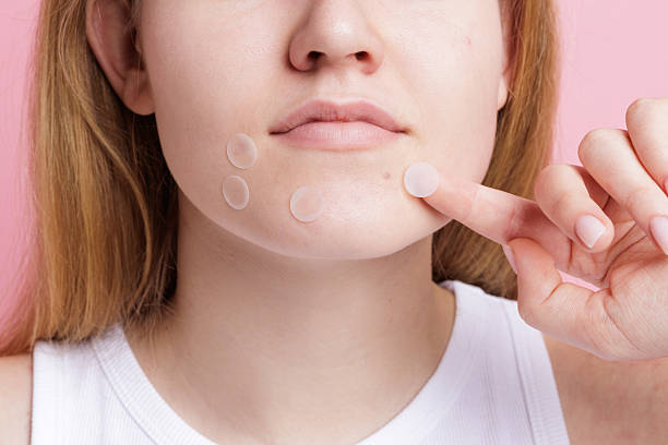 wanita muda menggunakan banyak acne patch di area dagu