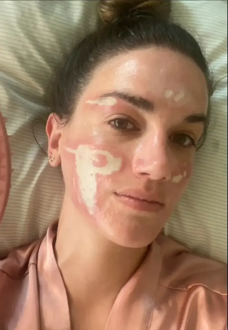 Dari Luka Bakar hingga Gagal Glow Up: Risiko Tersembunyi Treatment Estetika