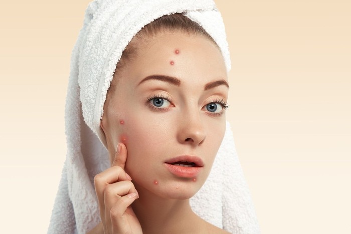 5 Masalah Kulit Umum dan Cara Mengatasinya Menurut Dermatolog