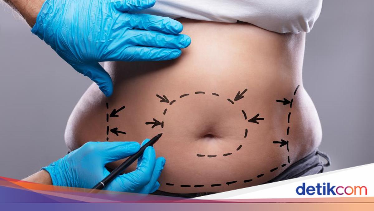 DIY Liposuction dan Tren Kecantikan Rumahan yang Berbahaya