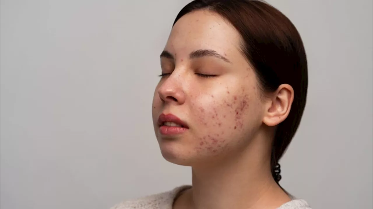 5 Cushion Lokal Terbaik untuk Kulit Berminyak Berjerawat yang Sensitif