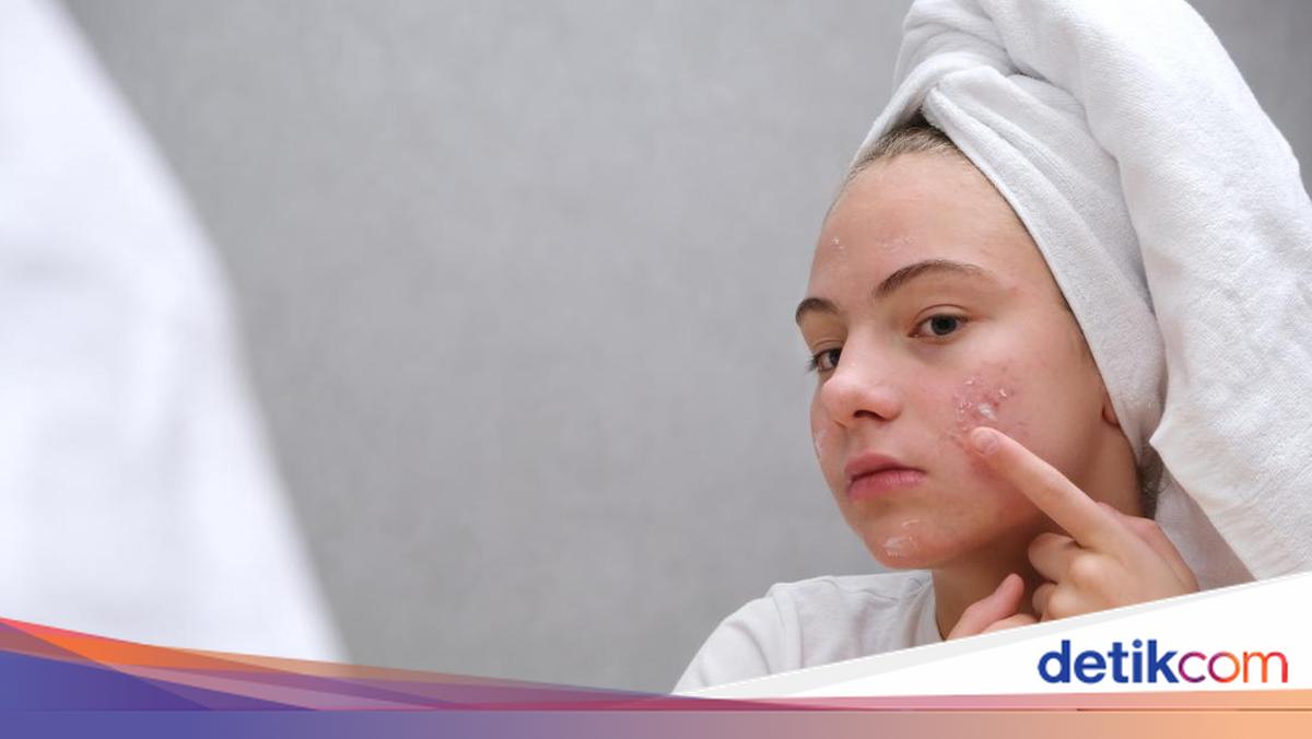 5 Kandungan Skincare Paling Efektif untuk Menghilangkan Bekas Jerawat