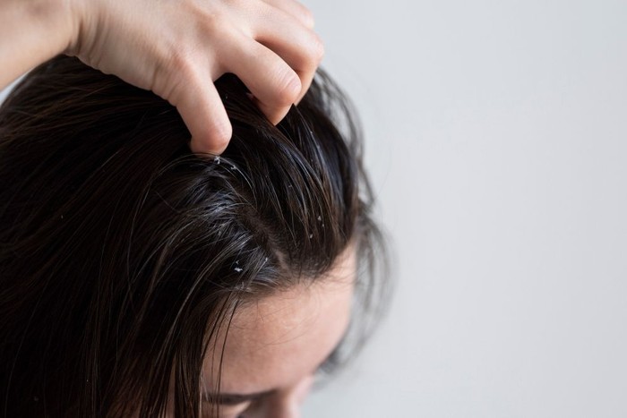 Panduan Dermatologi Mengatasi Ketombe Tanpa Merusak Kelembapan Rambut