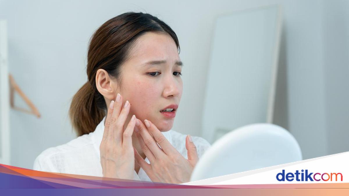 Melasma Dimulai dari Muda: Strategi Pencegahan dan Perawatan Efektif