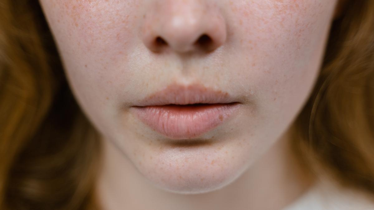 Mengapa Melasma Lebih Sering Dialami Perempuan Usia Produktif