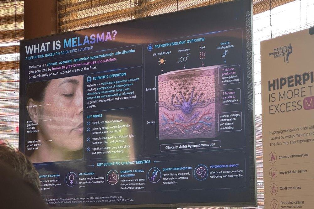 Melasma pada Perempuan Usia Produktif: Stres, Hormon, dan Bukan Sekadar Sinar Matahari