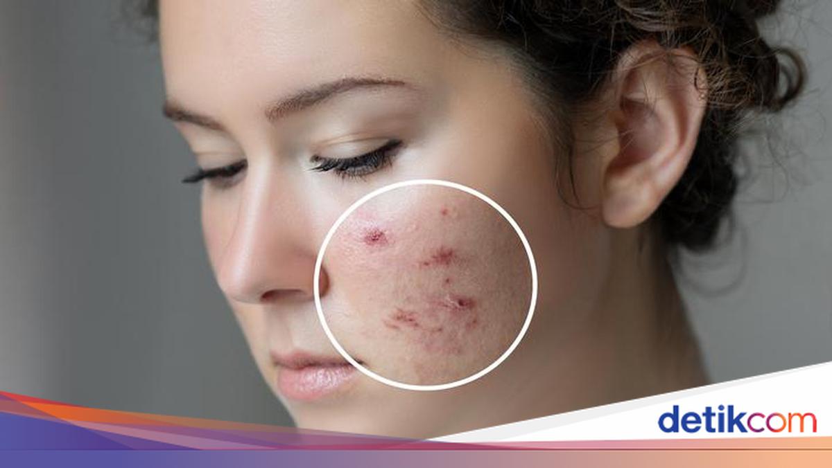 Makanan yang Memicu dan Mencegah Jerawat: Panduan Nutrisi untuk Kulit Bersih