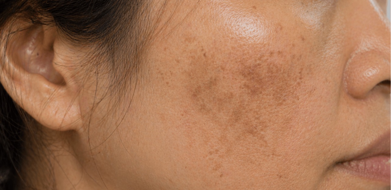 Melasma pada Wanita: Mengapa Lebih Rentan dan Bagaimana Mengendalikannya