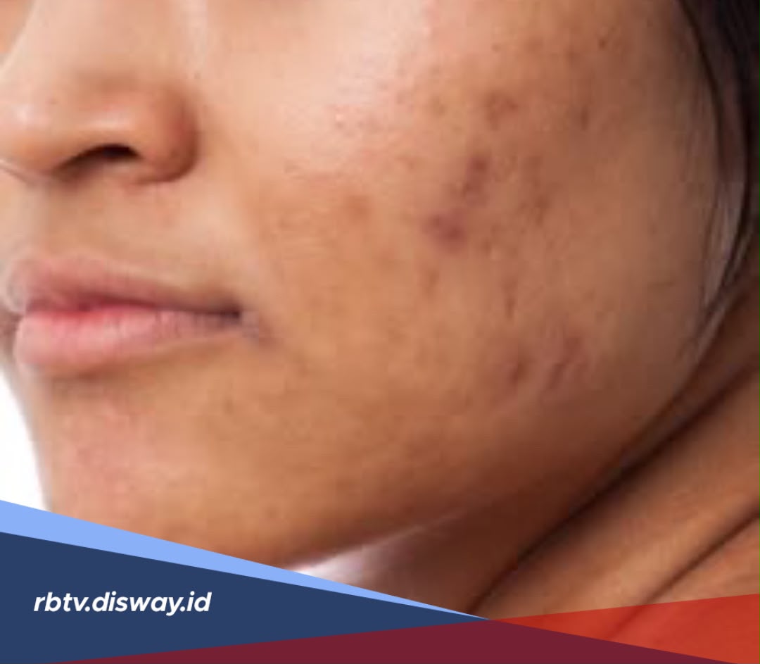 5 Krim Penghilang Bekas Jerawat Hitam PIH yang Paling Efektif