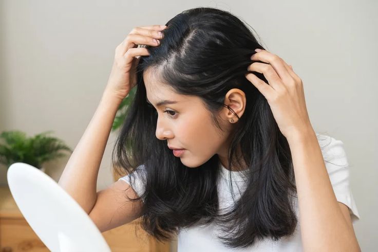 Ketombe Terus Kambuh? Pahami Siklus Kulit Kepala dan Cara Kontrol Jangka Panjang