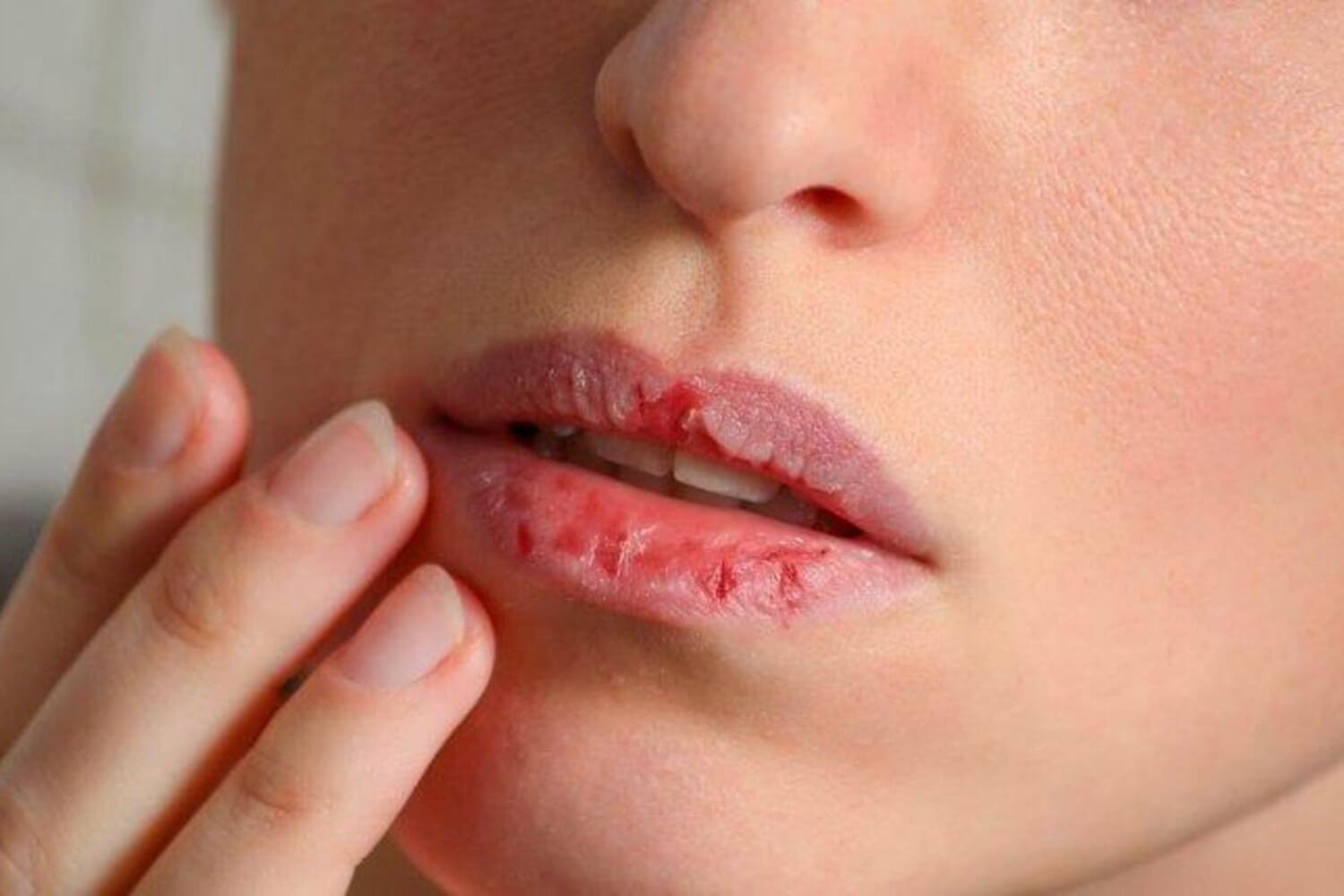5 Bahan Alami Ampuh Atasi Bibir Kering dan Pecah-pecah