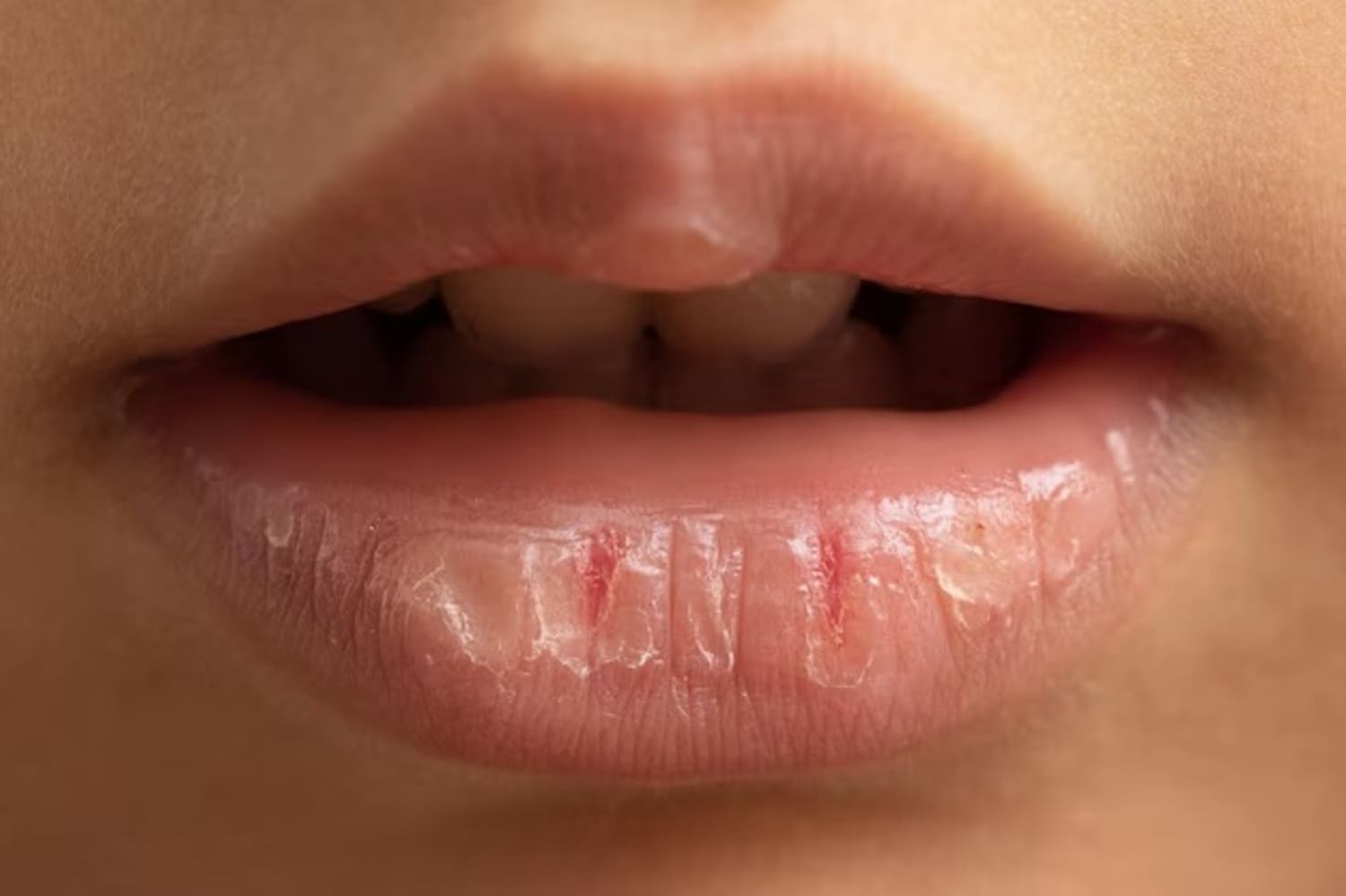 5 Bahan Alami untuk Mengatasi Bibir Kering dan Pecah-Pecah