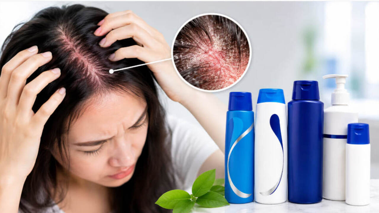 Kulit Kepala Gatal dan Ketombe Membandel: Panduan Memilih Shampo Dermatitis Seboroik