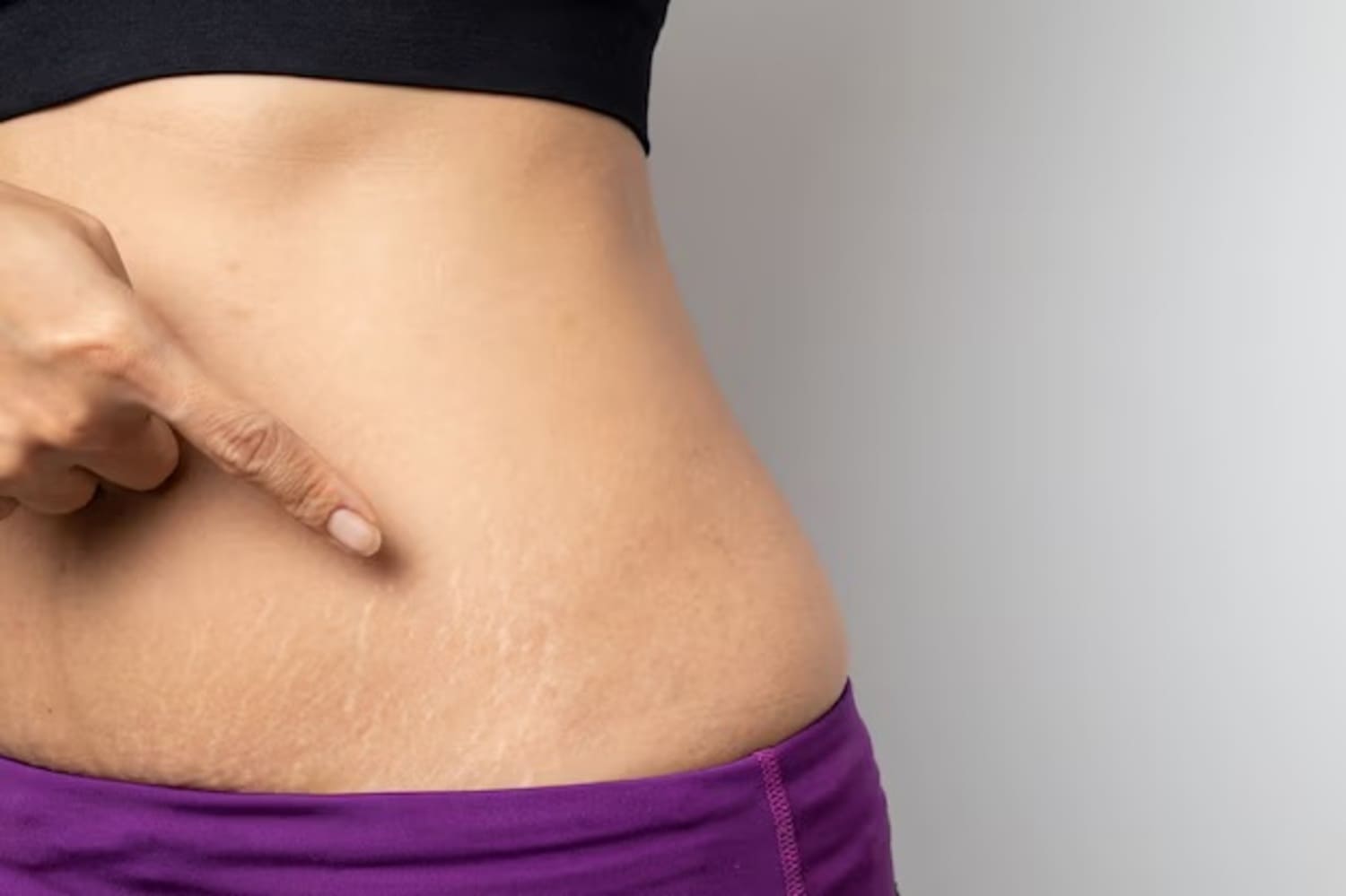 Panduan Skincare Aman Kehamilan dan Cara Alami Mengatasi Stretch Mark