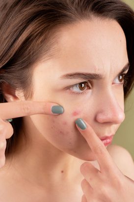 7 Skincare Terbaik untuk Kulit Berjerawat Remaja