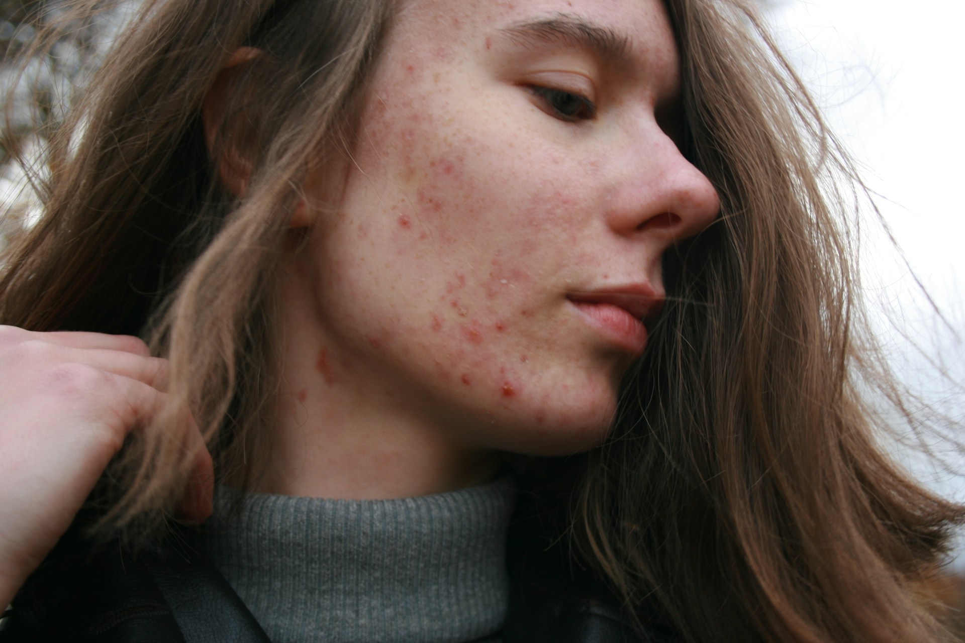 7 Skincare Terbaik untuk Kulit Berjerawat Remaja