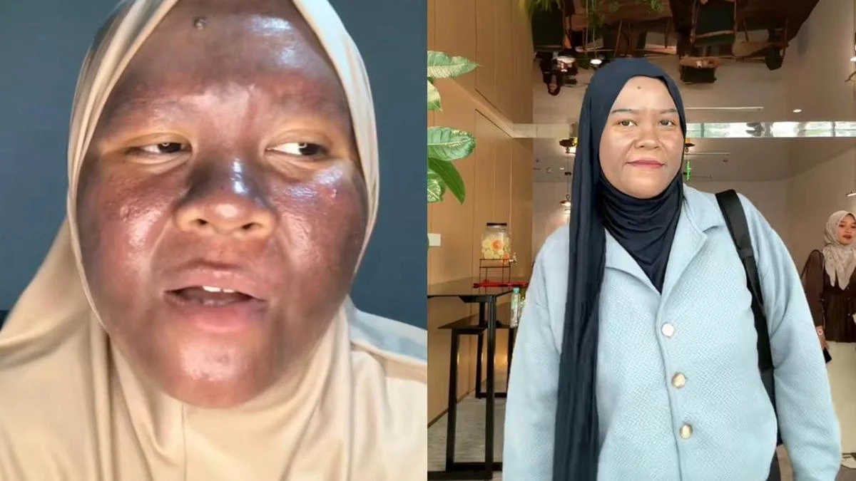 Dari Kulit Gelap hingga Pulih: Mengatasi Kerusakan Akibat Krim Merkuri