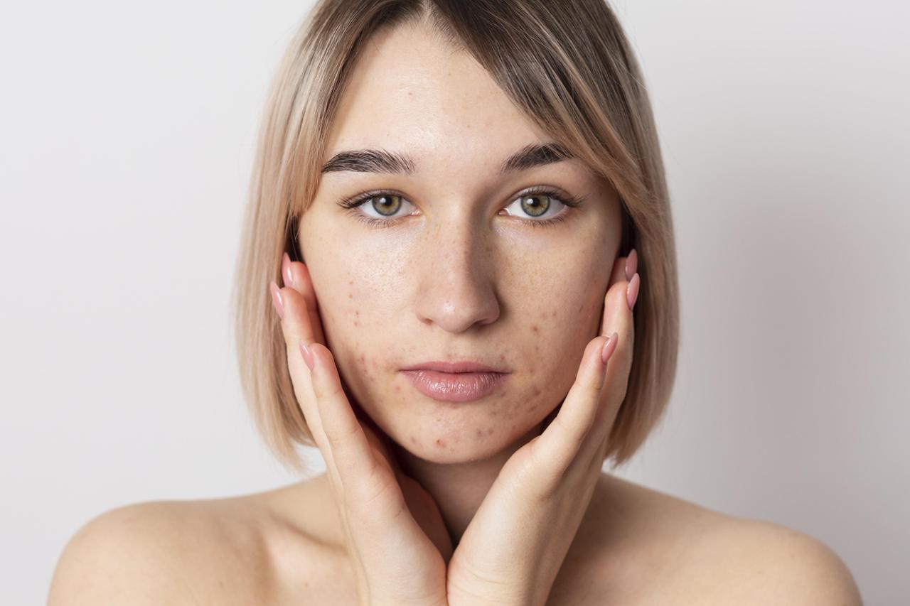 5 Tanda Skin Barrier Rusak dan Cara Memperbaikinya Secara Minimal