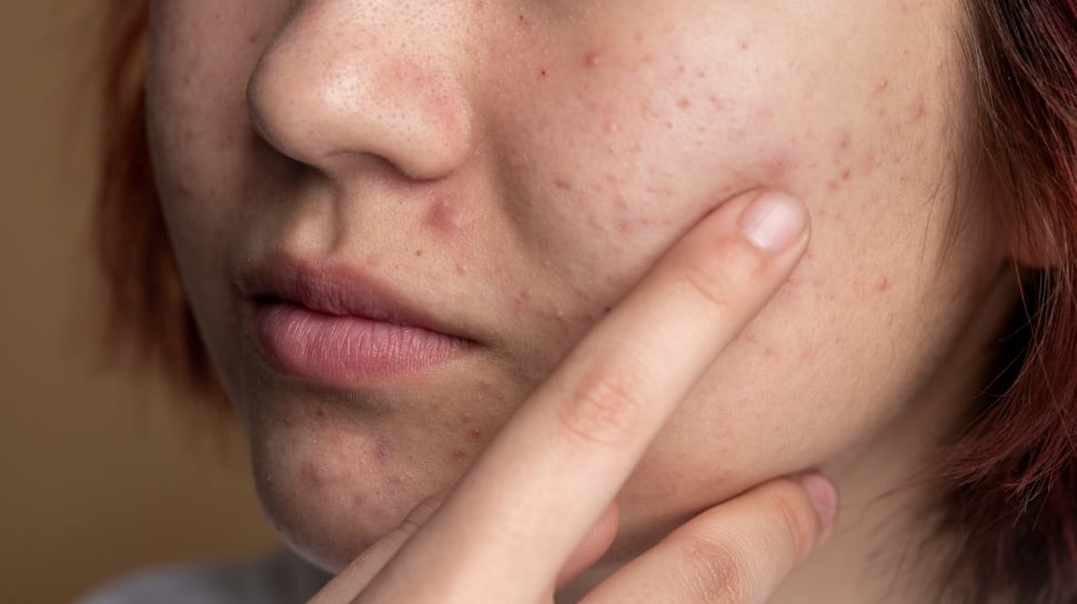 Salicylic Acid vs Azelaic Acid vs Tamanu Oil: Mana Paling Efektif Atasi Jerawat?